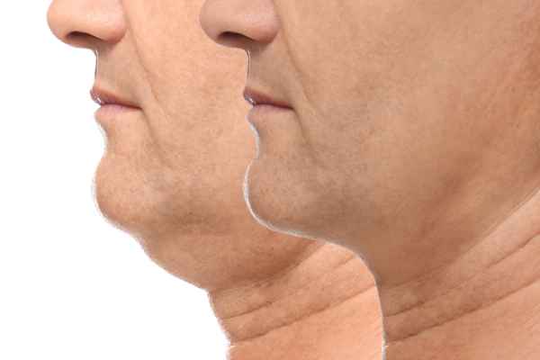 HIFU - Breakthrough in Anti - ageing 2 hifu results Derbyshire