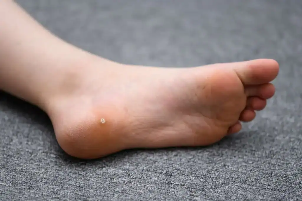 Cryotherapy For Warts And Also Verrucas 2 Image of verruca on the bottom of the foot that able to be treated with Cryotherapy Derbyshire