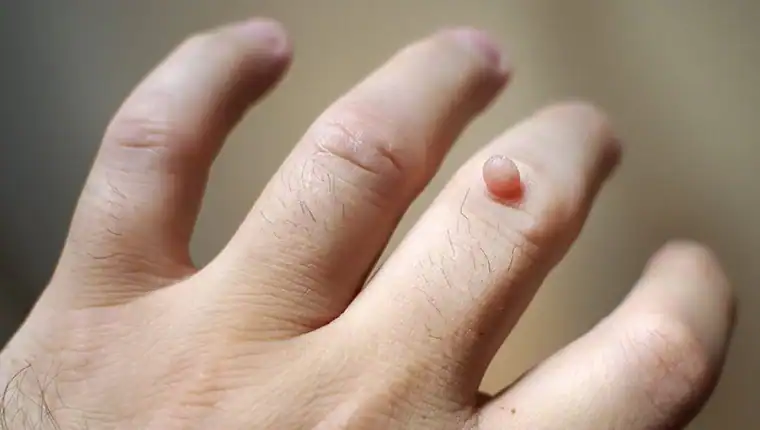 Image of blemish that Cryotherapy Derbyshire can remove with Lipo 360.