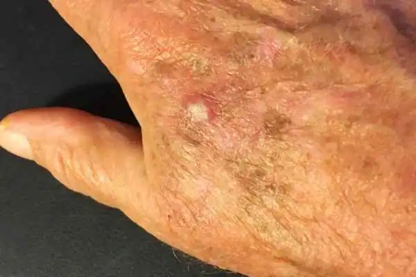 Image of Actinic keratoses Derbyshire on a person hand