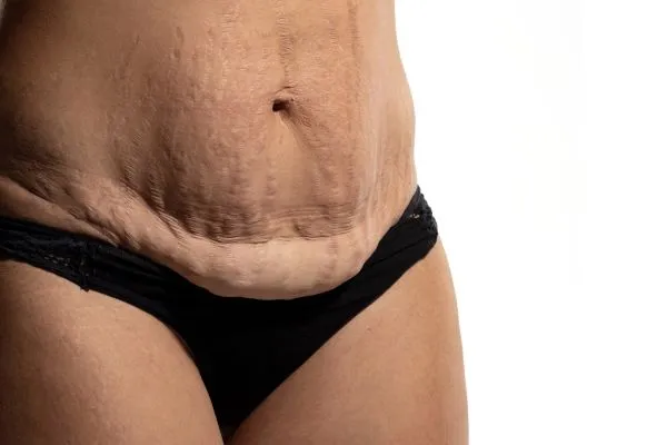 The science behind skin tightening Derbyshire picture of a woman's sagging skin on the stomach